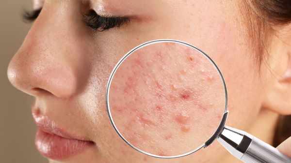  Know what is secretly triggering your acne