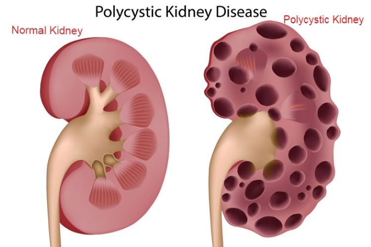  How does Polycystic Kidney Disease affect the kidneys?