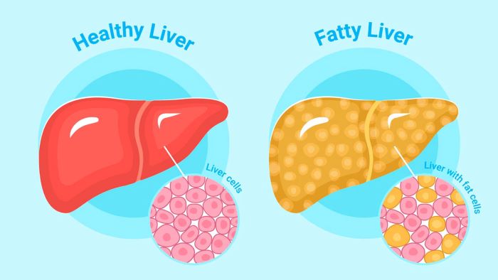  Fatty liver is the most prevalent illness affecting the liver worldwide