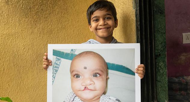 National Cleft Day is observed on February 8 every year