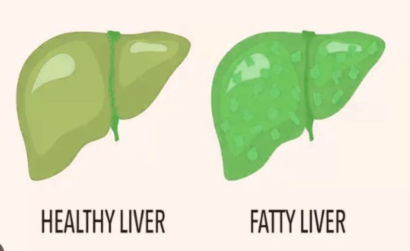  Rising cases of Non-Alcoholic Fatty Liver Disease a cause of concern