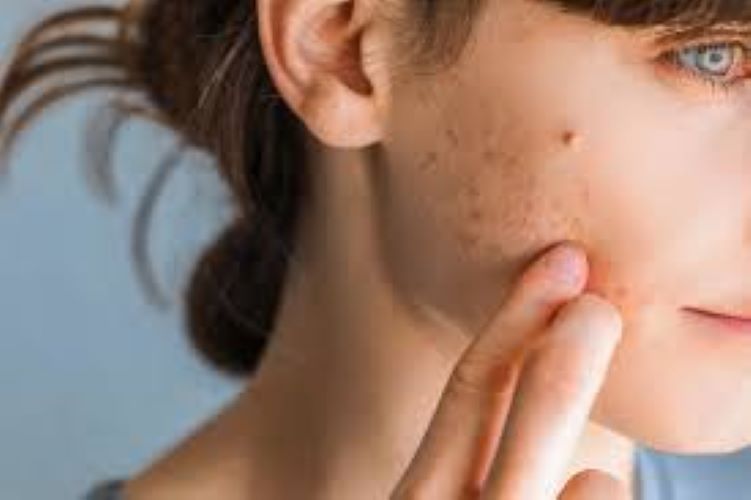  TEEN ACNE: SKINCARE ROUTINE FOR TEENAGERS WITH ACNE-PRONE SKIN