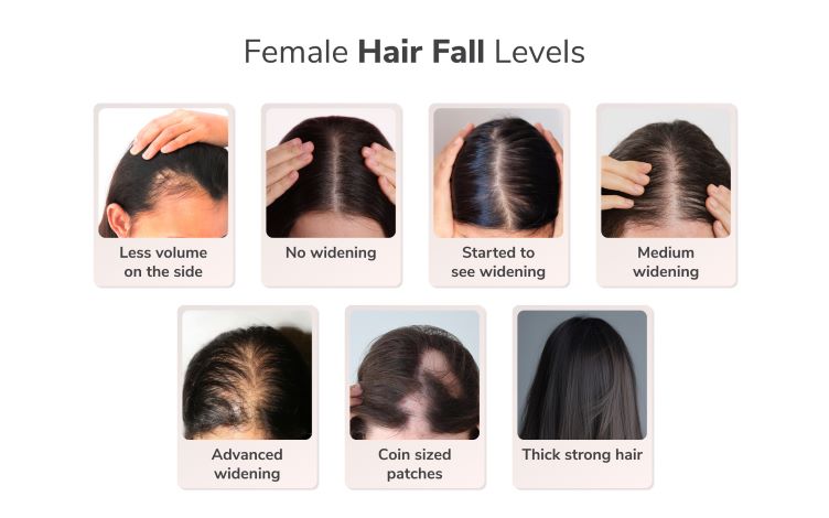  50% women between 36-40 years suffer from female pattern hair loss