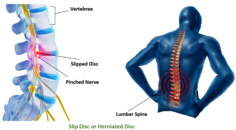  IS IT A DISC PROTRUSION?