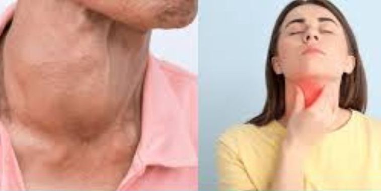  THYROID NODULES AND CANCER