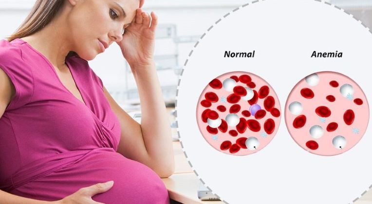  Pregnancy anemia linked to congenital heart defects in new born babies