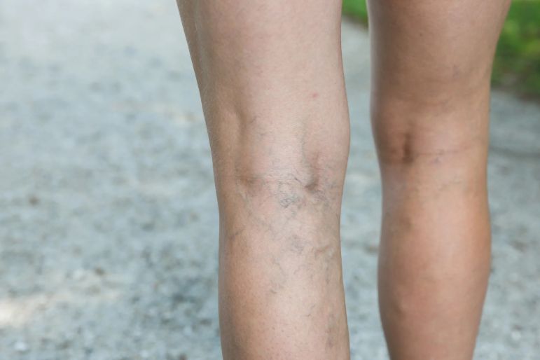  Varicose veins cases being detected in men