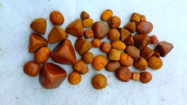 Spike in Cases of gallbladder stone in adults aged 40-50