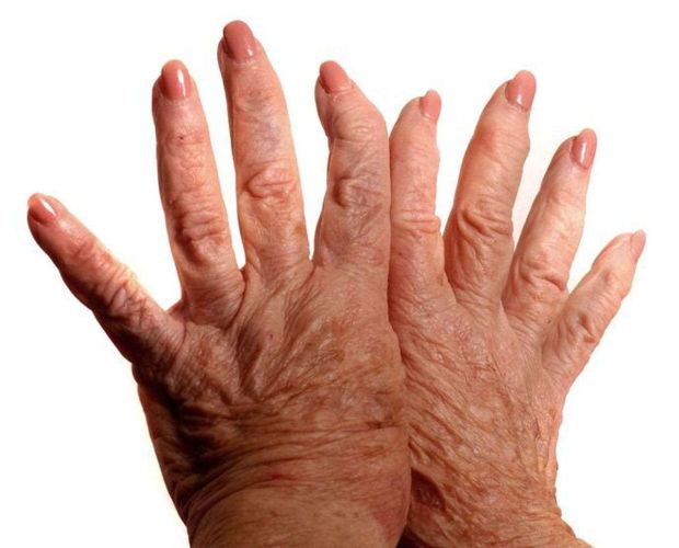  Arthritis Is Not the End of Mobility — Early Treatment Helps You Achieve Your Dreams