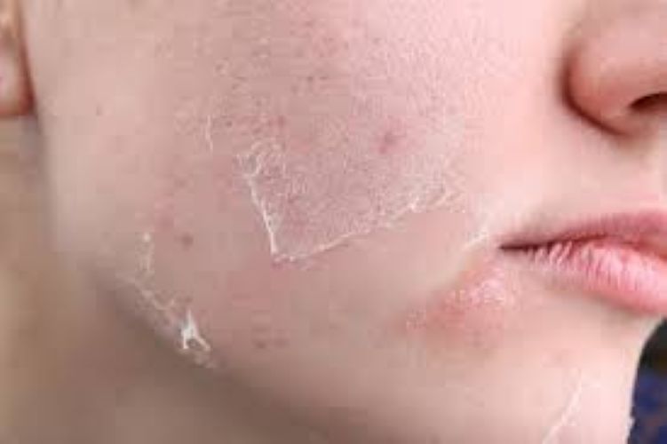  Skin Purging: Why Your Skin Gets Worse Before It Gets Better