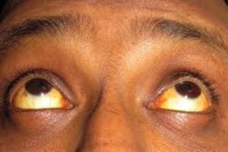  Jaundice not a seasonal illness anymore